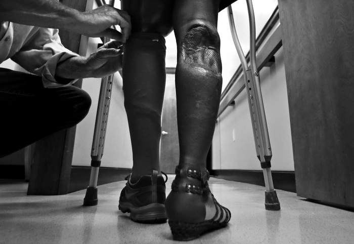 Mery Daniel, a Boston Marathon bombing survivor, stands as Paul Martino, of United Prosthetics, adjusts a cover the computerized knee and foot of her prosthetic left leg, at the company in the Dorchester neighborhood of Boston, Wednesday, June 26, 2013. Daniel's right leg also suffered significant damage in the blast, with the loss of calf muscles controlling her ankle and skin that was ripped away. The custom-made prosthetic leg features the most advanced technology of the day, but is clumsy compared to the leg that Daniel lost in the bombing.